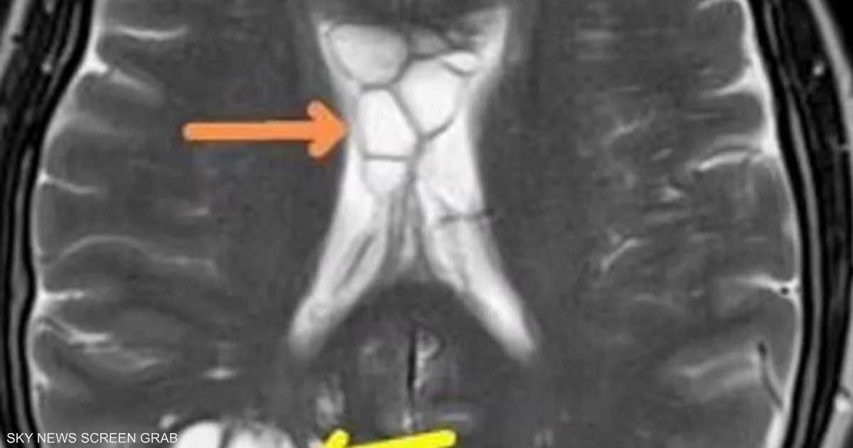 العالم اليوم - عانى من الصداع لأشهر.. السبب "دودة شريطة" داخل رأسه