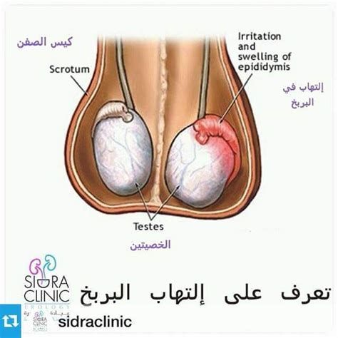 ألم الخصية اليسرى أسفل البطن