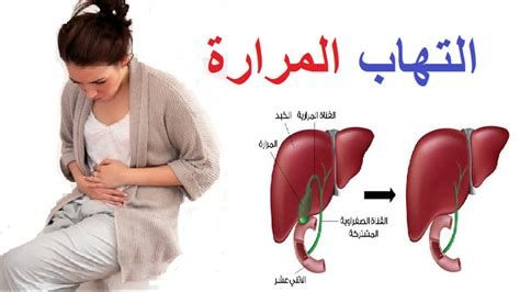 أين تقع المرارة في جسم الإنسان