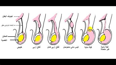 ألم الخصية اليسرى أسفل البطن