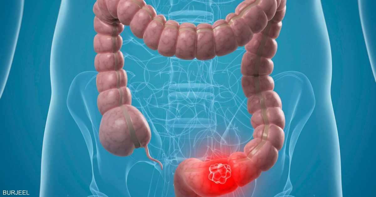 العالم اليوم - دراسة جديدة تكشف "أكبر عامل خطر" لسرطان القولون لدى الشباب