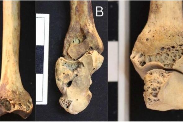 الكشف عن اقدم حالة التهاب المفاصل الروماتويدي في مصر القديمة حتى الآن
