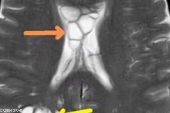العالم اليوم - عانى من الصداع لأشهر.. السبب "دودة شريطة" داخل رأسه