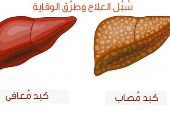 انــســف دهون الكبد كلها.. أعشاب تحمي خلايا الكبد وتمنعه من التليف!! هذا المشروب يجدد خلايا الكبد وأنزيماته